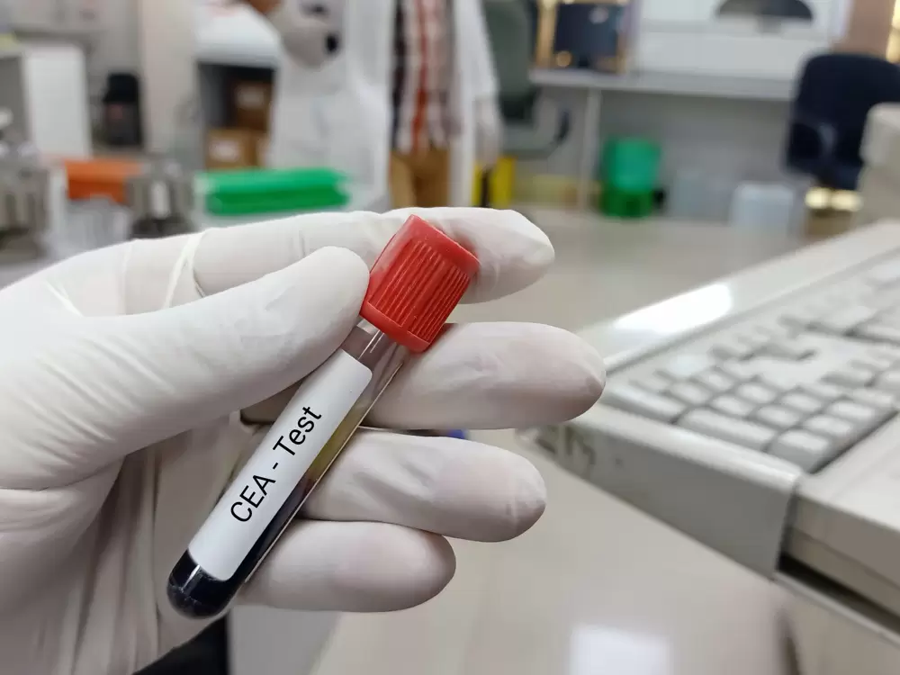 Biochemist or lab technologist holds blood sample for cea test, a tumor marker for colon cancer.