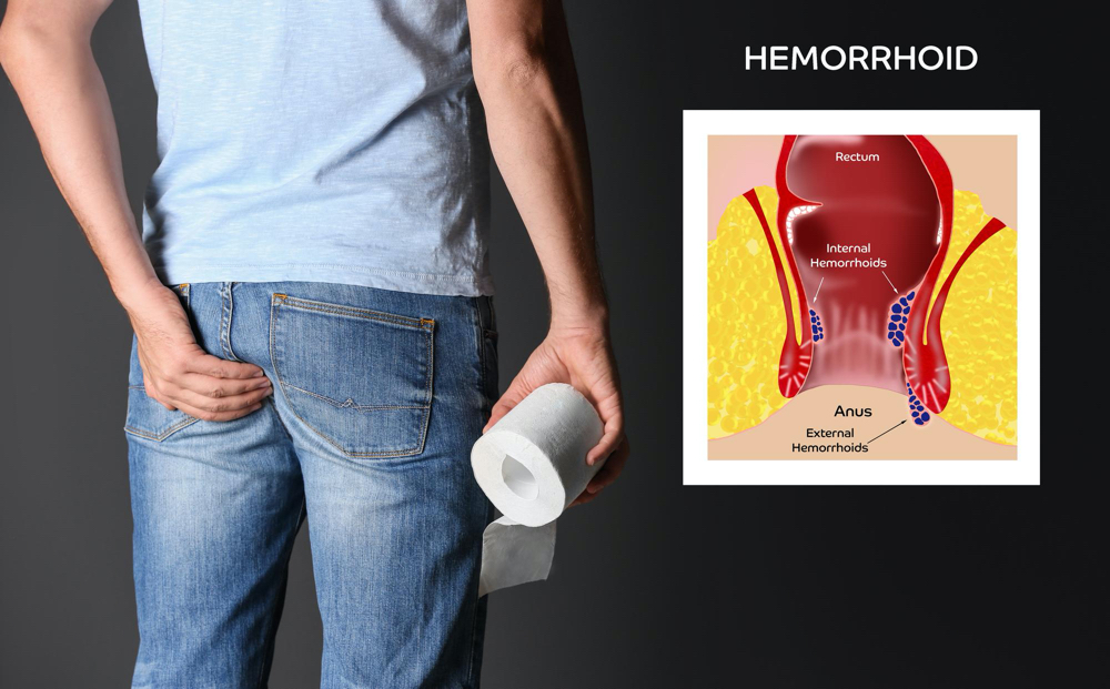 Photo man with toilet paper suffering from hemorrhoid pain on black background closeup illustration of unhealthy lowe