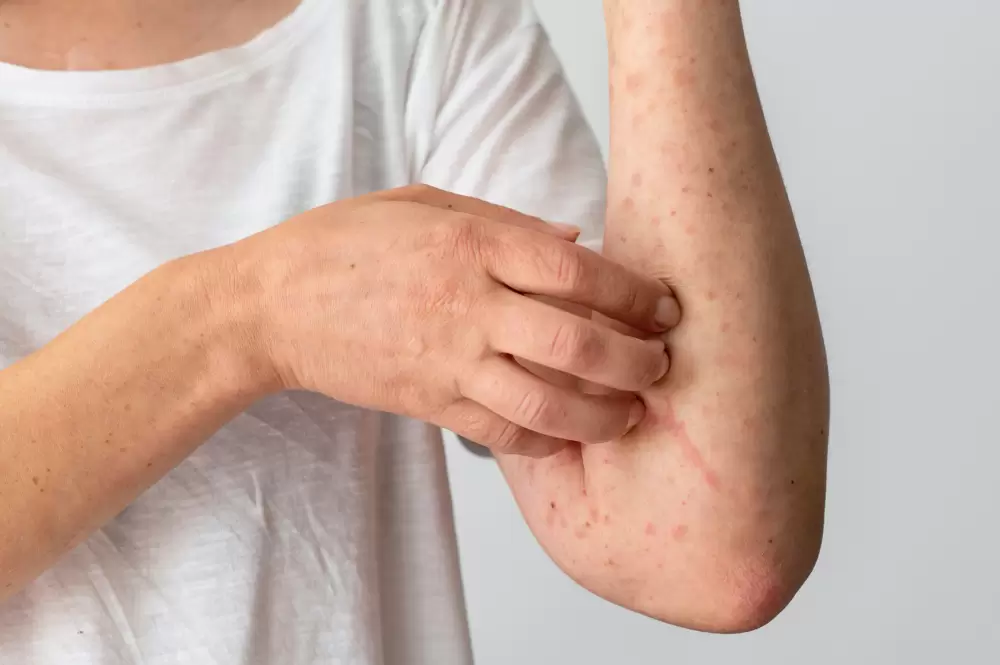 photo skin allergy reaction on person's arm